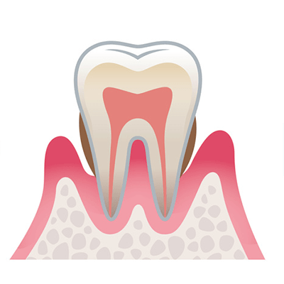 歯周病（中等度）