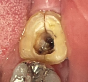 一番奥の歯の破折